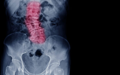 What is Scoliosis? – Signs, Diagnosis, and Treatment