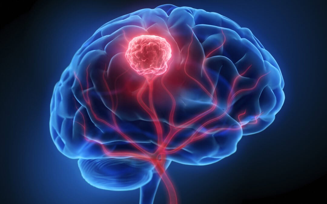 Image-Guided Laser Therapy for Brain Tumors: A New Era of Care in Northeast Wisconsin