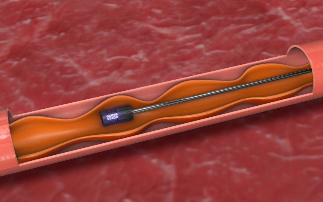 What Is Endovascular Treatment? A Minimally Invasive Approach to Vascular and Neurological Care