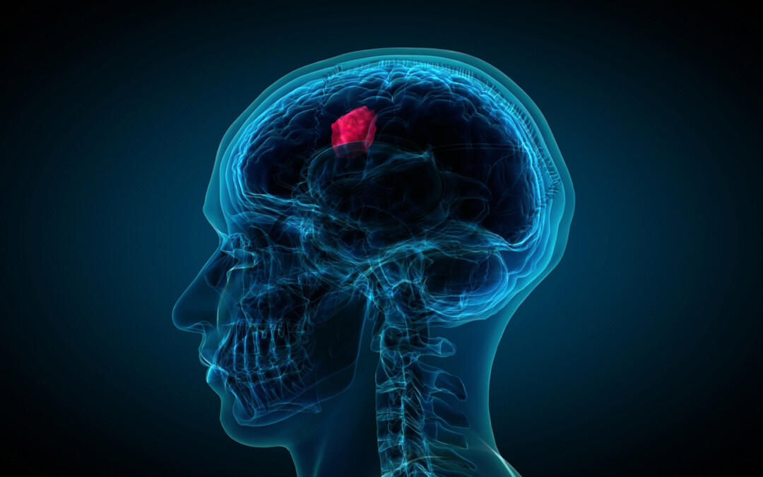 Brain Tumor Treatment Options: How LITT Compares to Traditional Approaches