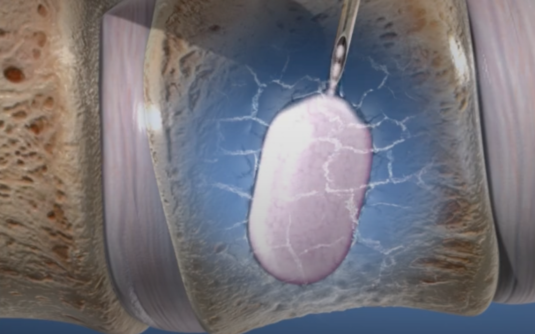 Compression Fracture Treatment: Minimally Invasive Options Like Kyphoplasty and Vertebroplasty