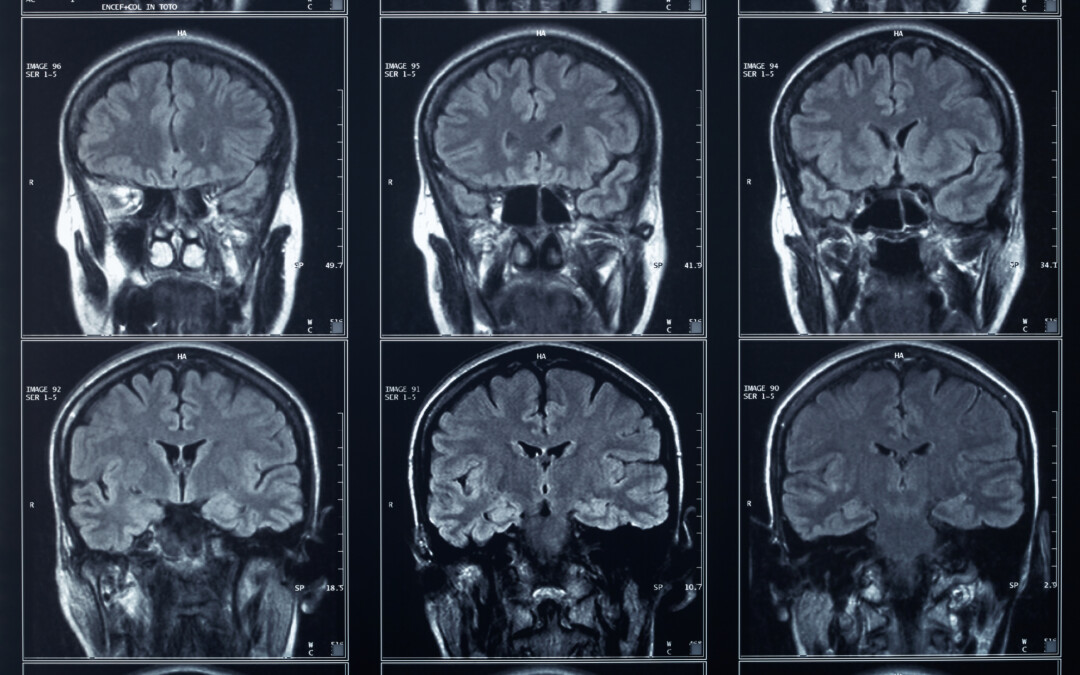 How Venous Sinus Stenting Treats Idiopathic Intracranial Hypertension